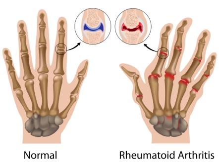 Rheumatoid arthritis joint changes to the wrist & hand